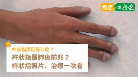 忤狀指|杵狀指原因是什麼？杵狀指是肺癌前兆？杵狀指照片、。